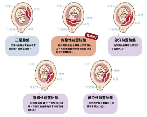 1988什麼年 完全性前置胎盤